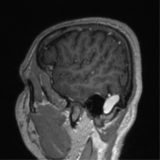 File:Cerebral venous thrombosis (Radiopaedia 38392-40469 Sagittal T1 C+ 73).png