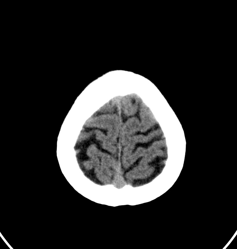 Cerebral venous thrombosis - CT only (Radiopaedia 41031-43778 Axial non-contrast 4).jpg