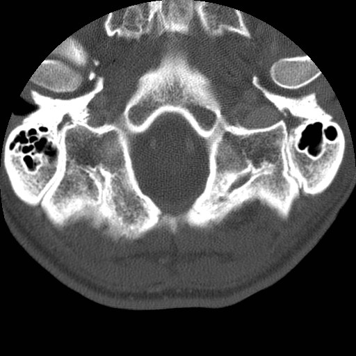 Cervical Pott disease (Radiopaedia 20374-20286 Axial bone window 8).jpg