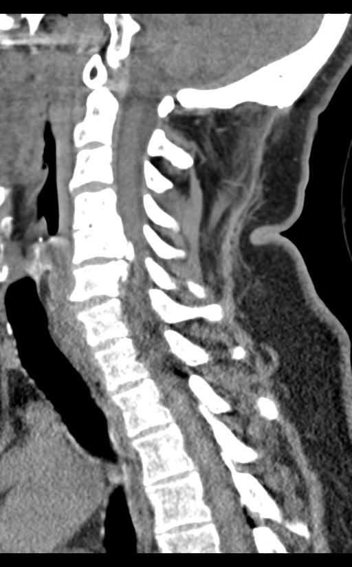 Cervical canal stenosis - OPLL and osteophytes (Radiopaedia 47329-51910 B 43).png