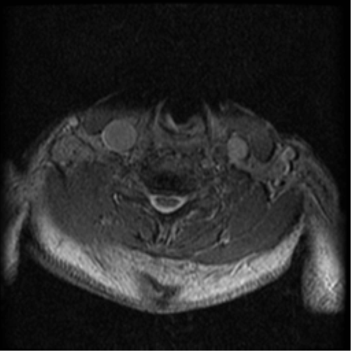 Cervical canal stenosis with cord compression (Radiopaedia 34114-35374 Axial Gradient Echo 32).png