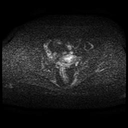 File:Cervical carcinoma (Radiopaedia 70924-81132 Axial DWI 44).jpg