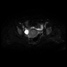 Cervical carcinoma (Radiopaedia 88010-104555 Axial DWI 11).jpg