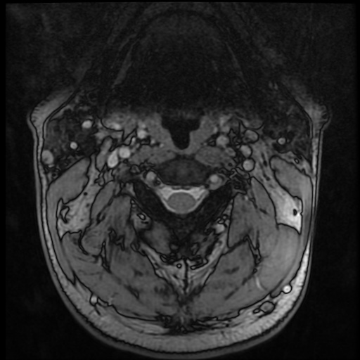 Cervical disc extrusion (Radiopaedia 59074-66364 G 8).jpg
