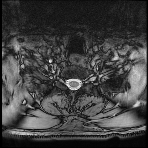 Cervical disc extrusion (Radiopaedia 59074-66364 G 98).jpg