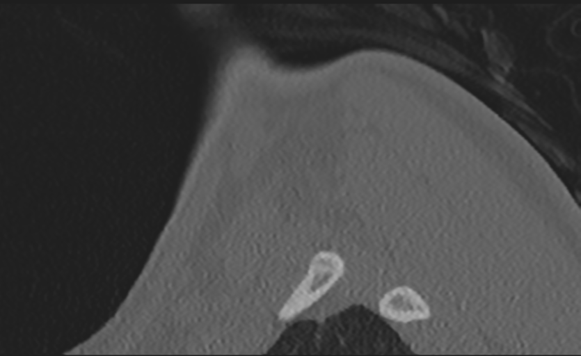 Cervical disc replacement (Radiopaedia 37383-39205 Sagittal bone window 2).png
