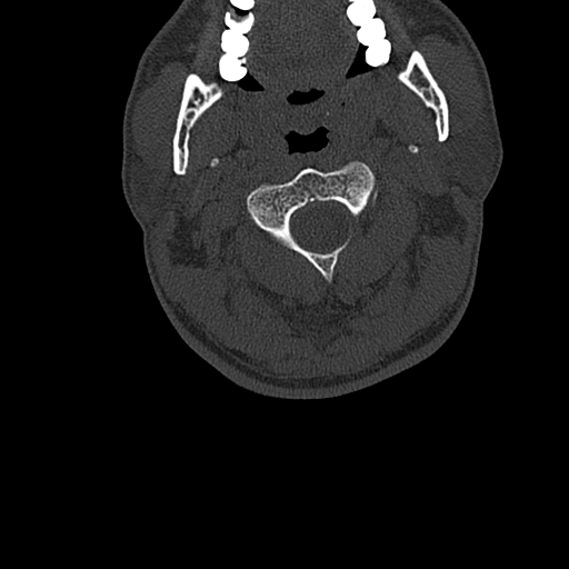 Cervical spine trauma with tear drop fracture and perched facet joint (Radiopaedia 53989-60127 Axial bone window 34).jpg