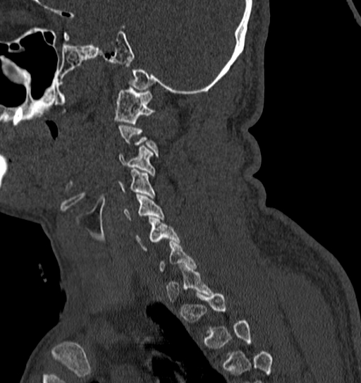 Cervical spine trauma with tear drop fracture and perched facet joint (Radiopaedia 53989-60127 Sagittal bone window 33).jpg