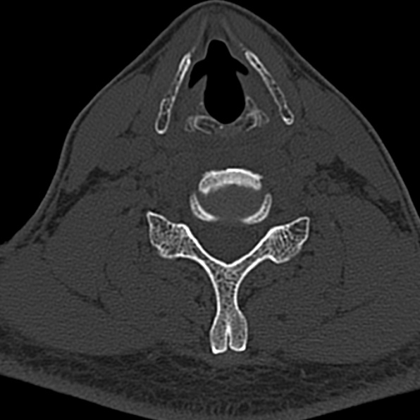 Cervical spondylodiscitis (Radiopaedia 28057-29489 Axial bone window 51).jpg