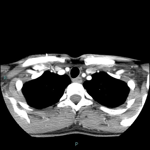 Cervical thymic cyst (Radiopaedia 88632-105335 B 24).jpg
