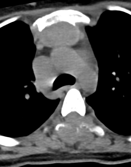 Cervical tuberculous spondylitis (Radiopaedia 39149-41365 Axial non-contrast 63).png