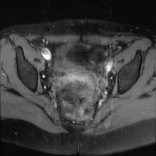 File:Cesarian section scar endometriosis (Radiopaedia 66520-75799 Axial T1 fat sat 14).jpg