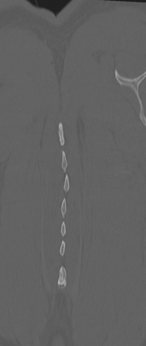 Chance fracture (Radiopaedia 33854-35020 Coronal bone window 82).png