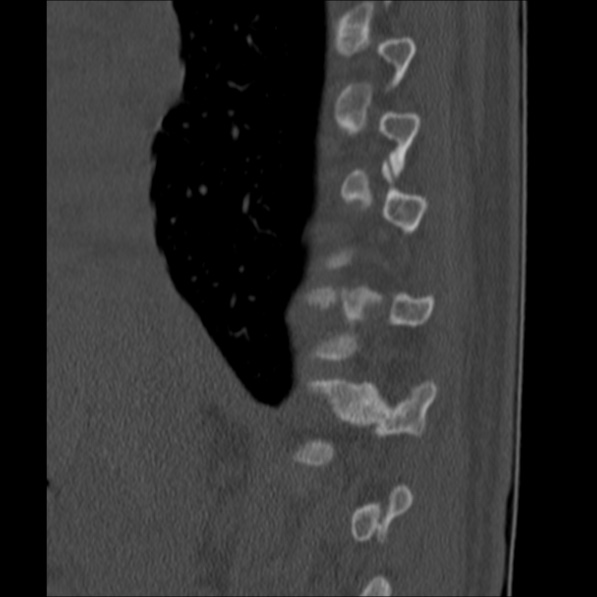 Chance fracture (Radiopaedia 36521-38081 Sagittal bone window 13).jpg
