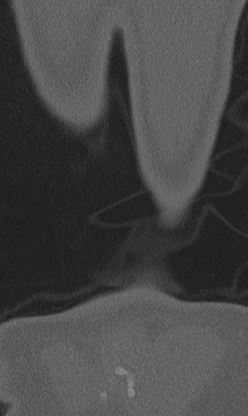 Chance fracture (Radiopaedia 40360-42912 Coronal bone window 74).png