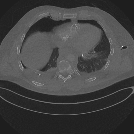 Chest multitrauma - aortic injury (Radiopaedia 34708-36147 Axial bone window 209).png