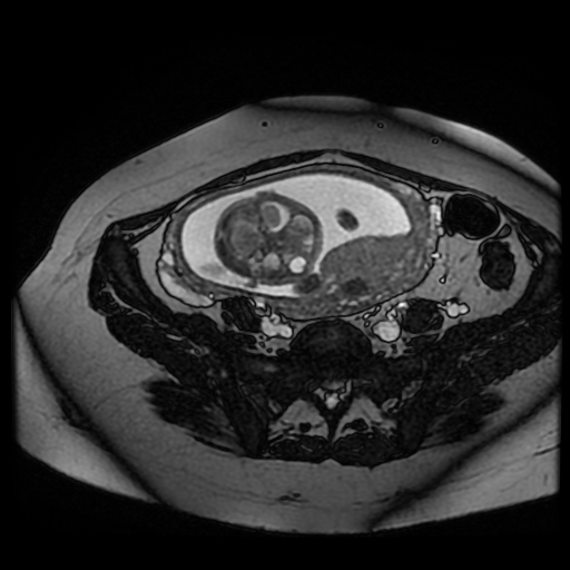 Chiari II malformation - fetal MRI (Radiopaedia 68099-77581 Axial Fiesta 35).jpg