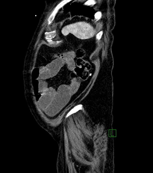 Cholangiocarcinoma with cerebral metastases (Radiopaedia 83519-98629 F 18).jpg