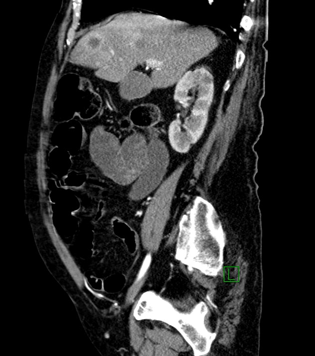 Cholangiocarcinoma with cerebral metastases (Radiopaedia 83519-98629 F 81).jpg