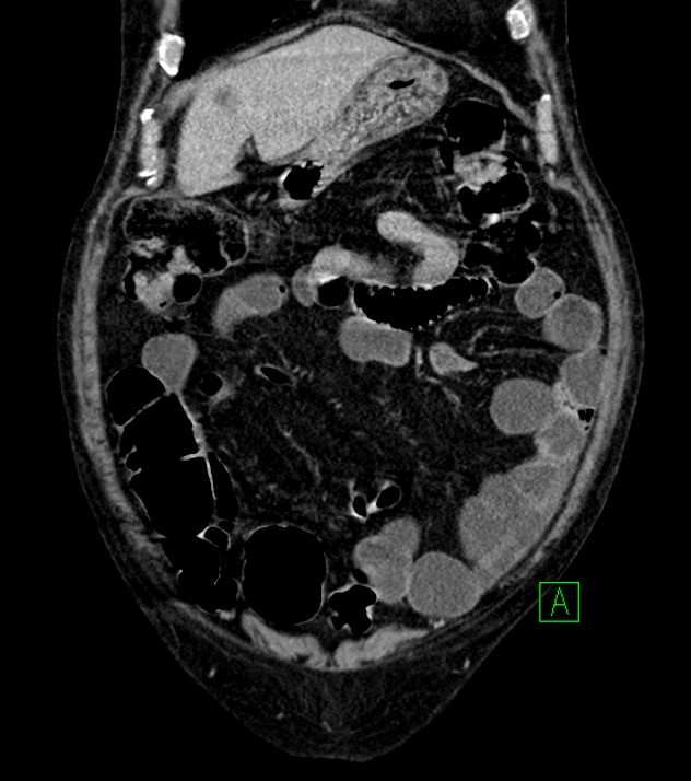 Cholangiocarcinoma with cerebral metastases (Radiopaedia 83519-98629 G 19).jpg