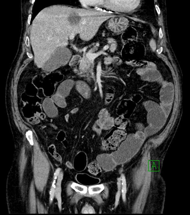 Cholangiocarcinoma with cerebral metastases (Radiopaedia 83519-98629 G 33).jpg