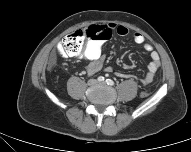 Cholecystitis - perforated gallbladder (Radiopaedia 57038-63916 A 54).jpg