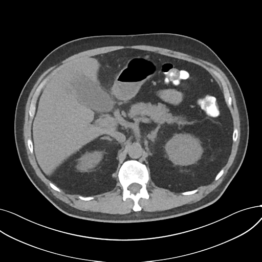 File:Cholecystitis with focal perforation and hepatic abscess (Radiopaedia 37189-38945 Axial non-contrast 26).png