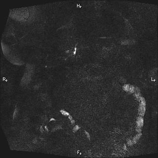 Choledochal cyst - type Ia (Radiopaedia 85673-101454 F 14).jpg