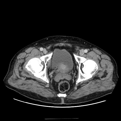 Choledocholiathiasis with normal caliber common bile duct (Radiopaedia 75368-86632 A 181).jpg