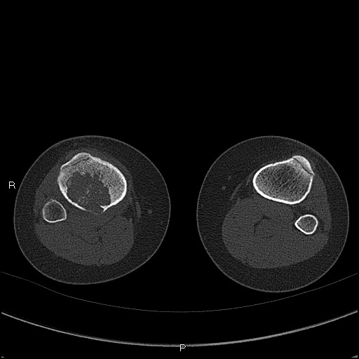 File:Chondroblastoma (Radiopaedia 62721-71030 Axial bone window 80).jpg