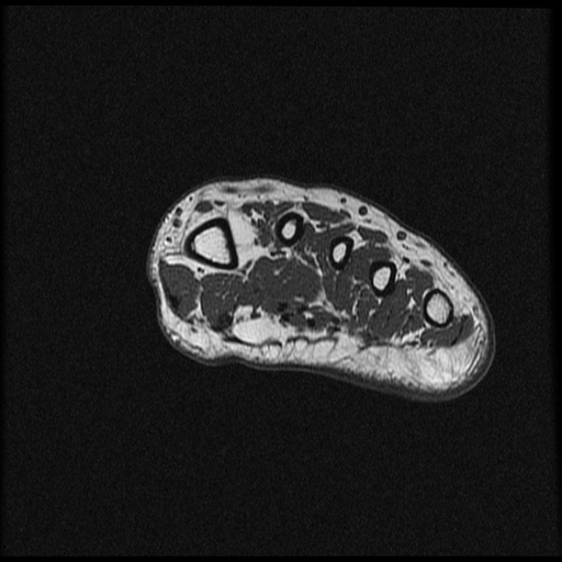 File:Chondroblastoma - midfoot (Radiopaedia 64831-73765 Short axis T1 26).jpg