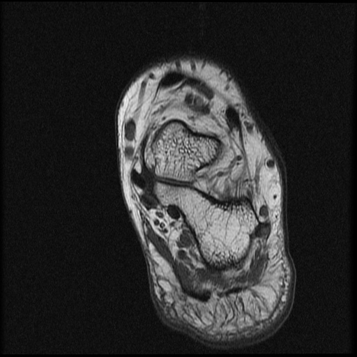 File:Chondroblastoma - midfoot (Radiopaedia 64831-73765 Short axis T1 3).jpg