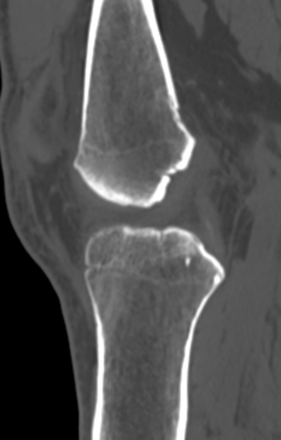 Chondrocalcinosis (Radiopaedia 82862-97173 Sagittal bone window 31).jpg