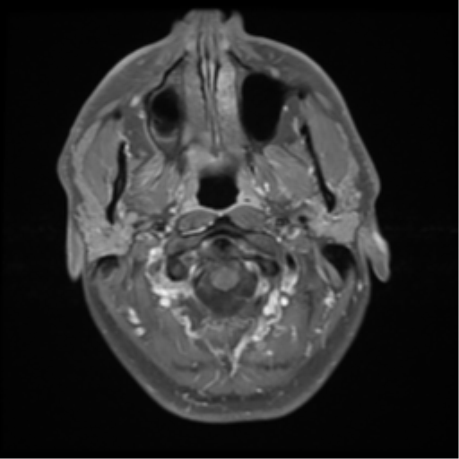 File:Chondrosarcoma (clivus) (Radiopaedia 46895-51424 Axial STIR 5).png