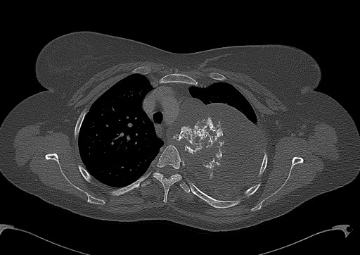 Chondrosarcoma - chest wall (Radiopaedia 65192-74199 Axial bone window 38).jpg