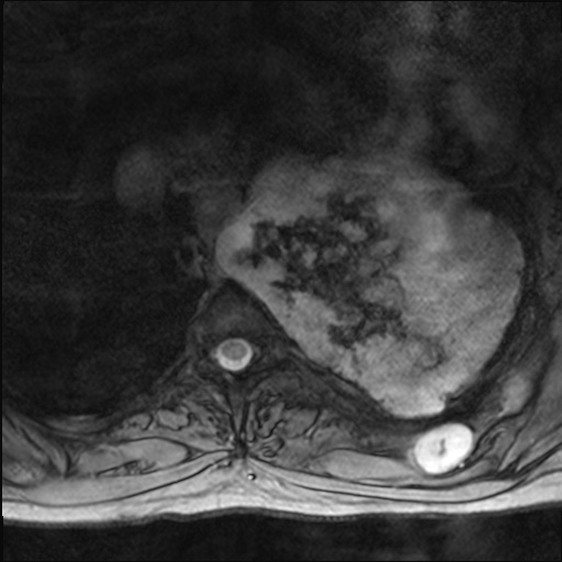 File:Chondrosarcoma - chest wall (Radiopaedia 65192-74200 Axial Gradient Echo 25).jpg