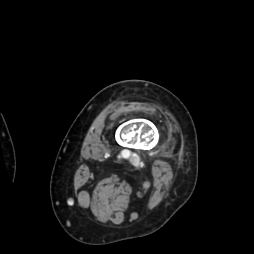 Chondrosarcoma - femur (Radiopaedia 64187-72954 Axial with contrast 17).jpg