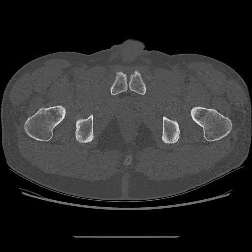File:Chondrosarcoma of iliac wing (Radiopaedia 63861-72599 Axial bone window 117).jpg