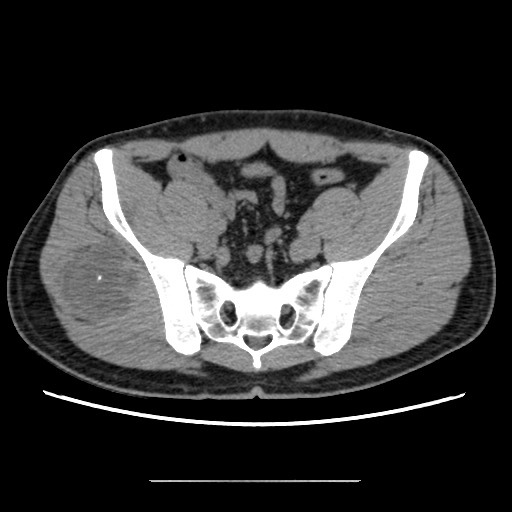 Chondrosarcoma of iliac wing (Radiopaedia 63861-72599 Axial non-contrast 63).jpg