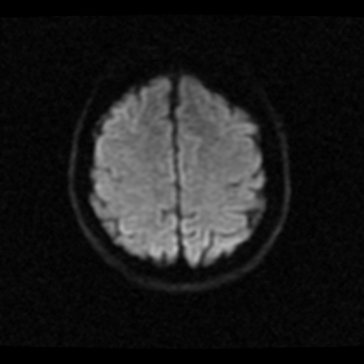 File:Choroid plexus xanthogranuloma (Radiopaedia 17650-17386 DWI 5).jpg