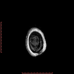Choroid plexus xanthogranuloma (Radiopaedia 67843-77270 Axial T1 17).jpg