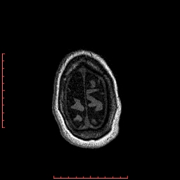 Choroid plexus xanthogranuloma (Radiopaedia 67843-77270 Axial T1 25).jpg