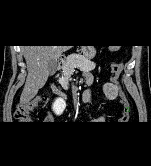Chromophobe renal cell carcinoma (Radiopaedia 84286-99573 E 12).jpg