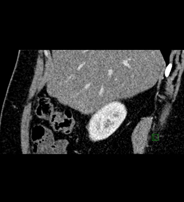 Chromophobe renal cell carcinoma (Radiopaedia 84286-99573 F 136).jpg
