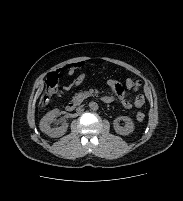 Chromophobe renal cell carcinoma (Radiopaedia 84337-99693 Axial non-contrast 56).jpg