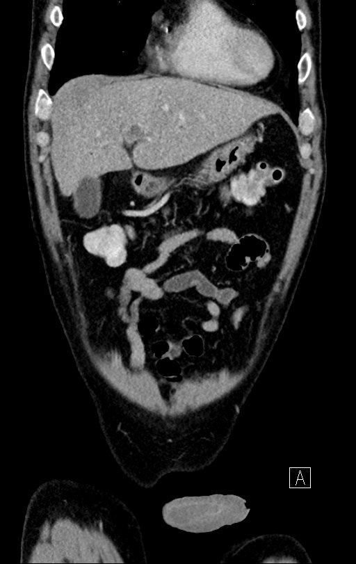 Chronic appendicitis complicated by appendicular abscess, pylephlebitis and liver abscess (Radiopaedia 54483-60700 C 18).jpg