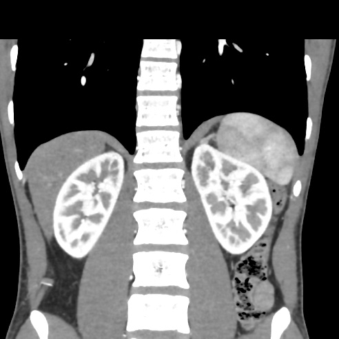 File:Chronic calcific pancreatitis (Radiopaedia 56280-62953 E 24).jpg