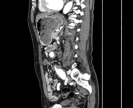 File:Chronic contained rupture of abdominal aortic aneurysm with extensive erosion of the vertebral bodies (Radiopaedia 55450-61901 B 46).jpg