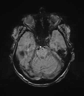 Chronic hypertensive encephalopathy (Radiopaedia 72844-83495 Axial SWI magnitude 26).png