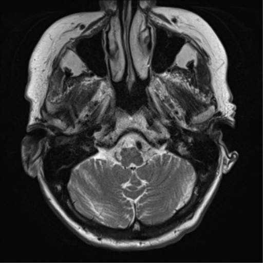 File:Chronic hypertensive encephalopathy (Radiopaedia 72844-83495 Axial T2 6).png